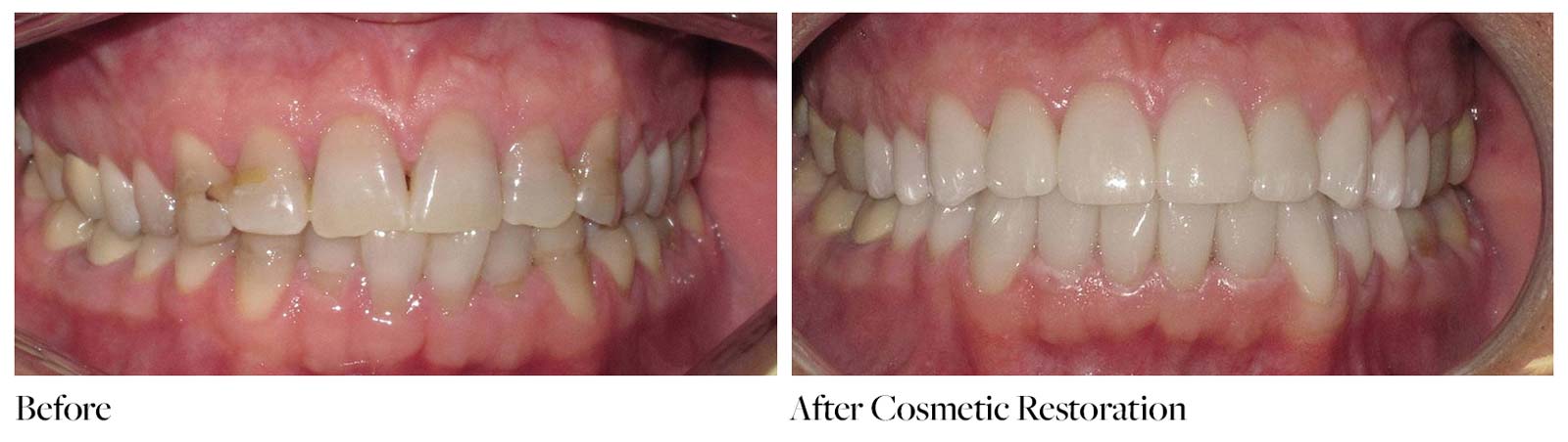 Before and after cosmetic restoration teeth