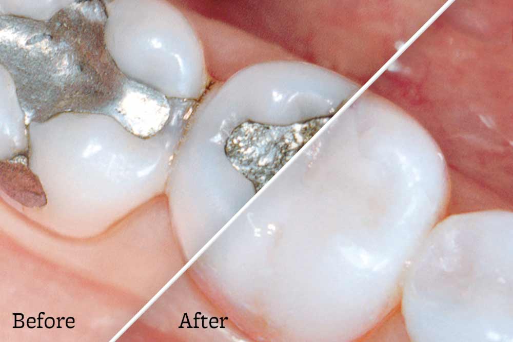 Before and After mercury free fillings