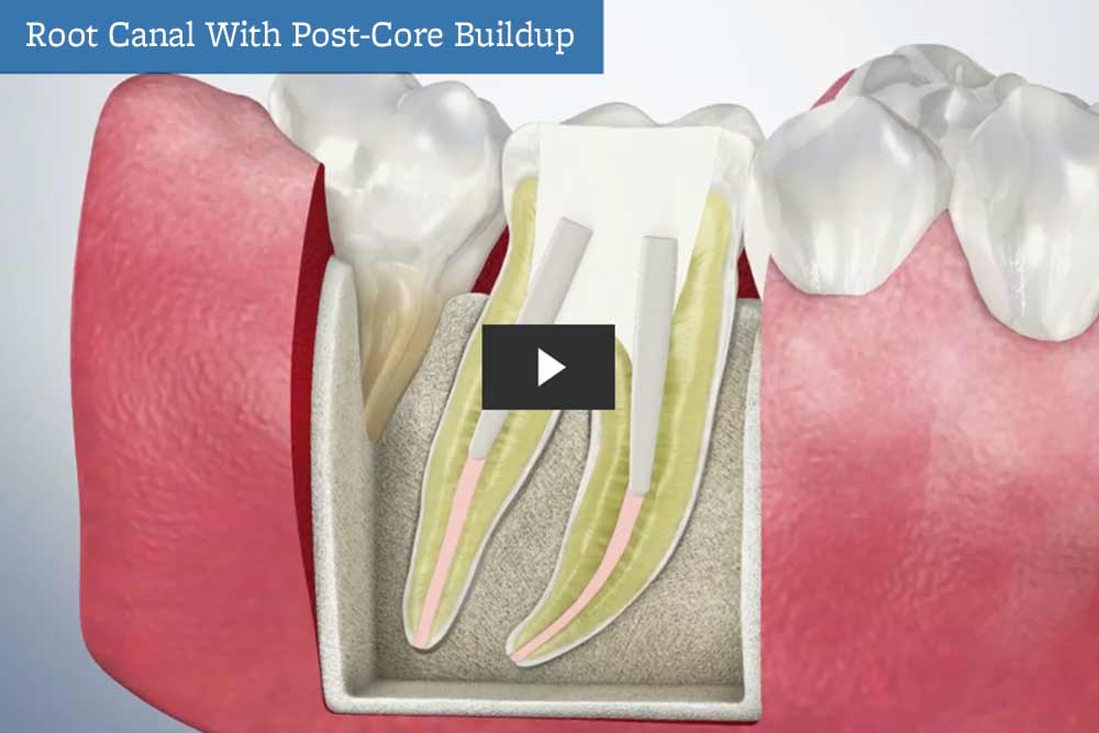 Root Canal with Post-Core Buildup video